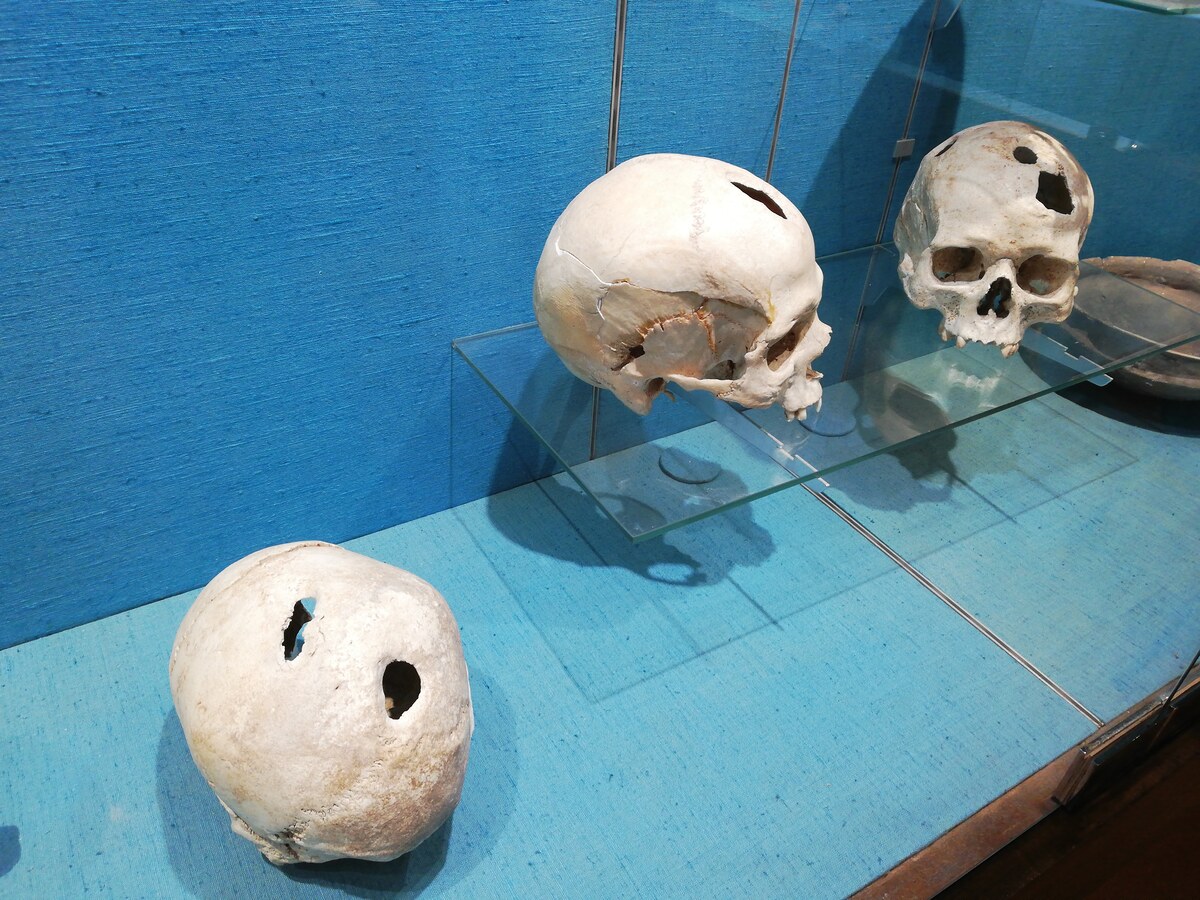 Neolithic trepanned skulls